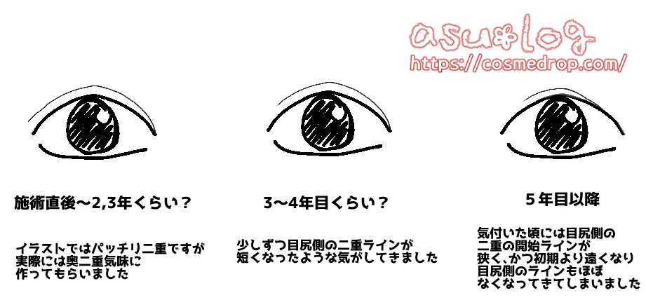 私の埋没法の経過具合